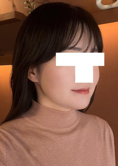 윤곽 5주차, 턱처짐 없고 옆에서 본 턱라인이 엄청 갸름해졌어요 사진 6 — 아바성형외과 이중턱·윤곽 후기