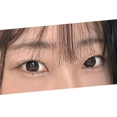 눈밑지방재배치 4주차, 붓기 1도 없고 이목구비가 살았어요 — 아바성형외과 환자 후기 사진
