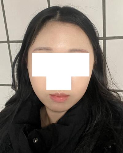 눈밑 수술 7주차, 잔붓기 빼면 완전 티도 안 나서 만족해요 — 아바성형외과 환자 후기 사진