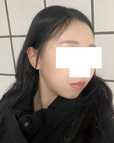 눈밑 수술 7주차, 잔붓기 빼면 완전 티도 안 나서 만족해요 사진 5 — 아바성형외과 눈밑지방재배치 후기