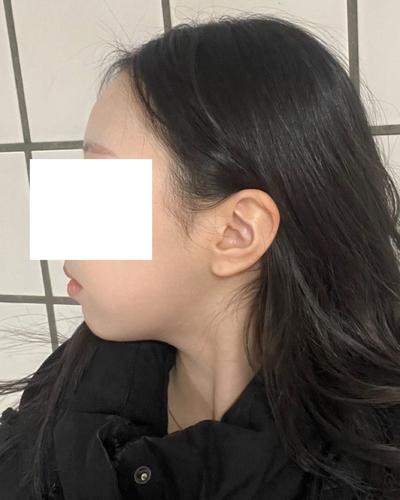 눈밑 수술 7주차, 잔붓기 빼면 완전 티도 안 나서 만족해요 사진 6 — 아바성형외과 눈밑지방재배치 후기
