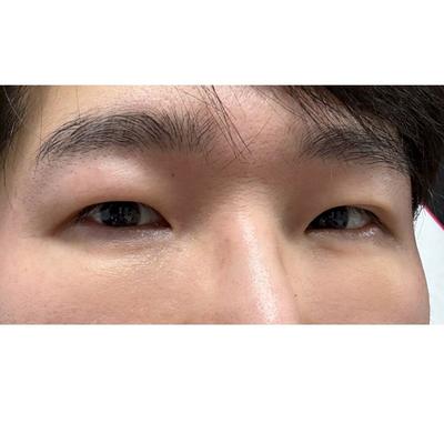 눈밑지방재배치 2주차, 잔붓기 빠지면서 확 나아지는 게 보여요 — 아바성형외과 환자 후기 사진