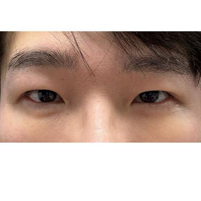 눈밑지방재배치 2주차, 잔붓기 빠지면서 확 나아지는 게 보여요 사진 4 — 아바성형외과 눈밑지방재배치 후기
