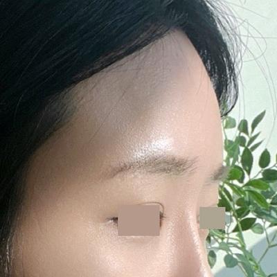 이마거상 축소술 6주차, 눈매까지 또렷해져 마음에 들어요 — 아바성형외과 환자 후기 사진