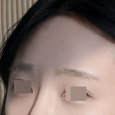 이마거상 축소술 6주차, 눈매까지 또렷해져 마음에 들어요 사진 4 — 아바성형외과 안면거상 후기