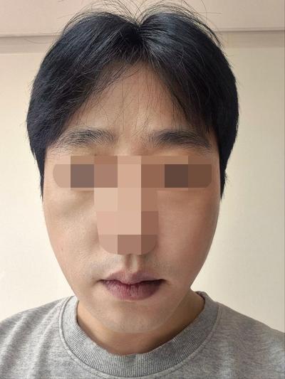 이마거상 4주차, 눈썹 처짐 올라가고 주름까지 펴졌어요 — 아바성형외과 환자 후기 사진