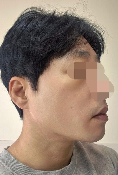 이마거상 4주차, 눈썹 처짐 올라가고 주름까지 펴졌어요 사진 5 — 아바성형외과 안면거상 후기