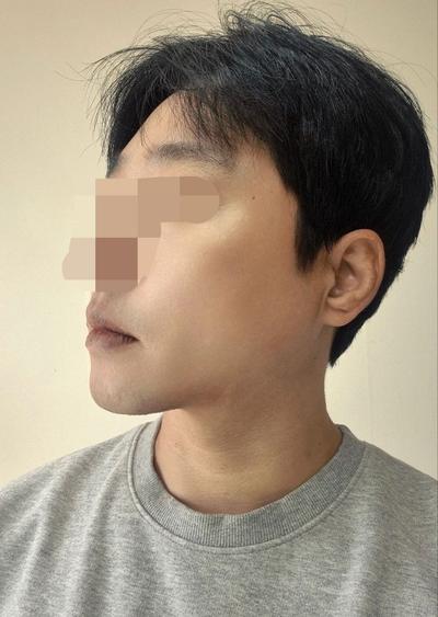 이마거상 4주차, 눈썹 처짐 올라가고 주름까지 펴졌어요 사진 6 — 아바성형외과 안면거상 후기