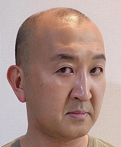 눈성형 환자 후기 — 눈밑지하고 인상이 깔끔해진 ... (448)