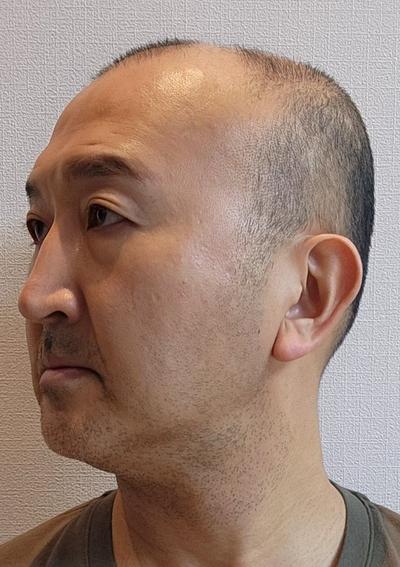 눈밑지방재배치 7주차, 피곤해보인다는 소리 이제 안 들어요 사진 2 — 아바성형외과 눈밑지방재배치 후기