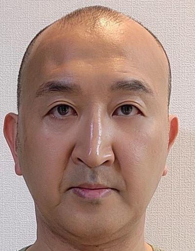 눈밑지방재배치 7주차, 피곤해보인다는 소리 이제 안 들어요 사진 4 — 아바성형외과 눈밑지방재배치 후기