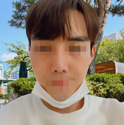 코수술 4주차, 휜 코랑 주저앉은 코끝 예쁘게 자리잡고 있어요 — 아바성형외과 환자 후기 사진