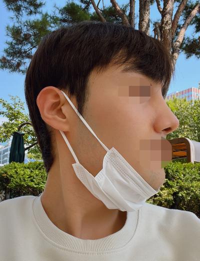코수술 4주차, 휜 코랑 주저앉은 코끝 예쁘게 자리잡고 있어요 사진 4 — 아바성형외과 코성형 후기