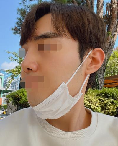 코수술 4주차, 휜 코랑 주저앉은 코끝 예쁘게 자리잡고 있어요 사진 5 — 아바성형외과 코성형 후기