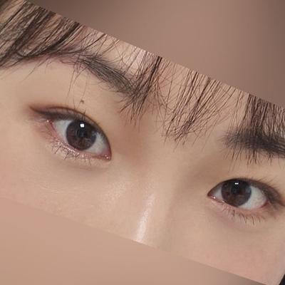 눈밑지방재배치 4주차, 붓기 싹 빠지고 눈밑이 매끈하고 환해졌어요 — 아바성형외과 환자 후기 사진