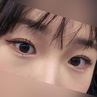 눈밑지방재배치 4주차, 붓기 싹 빠지고 눈밑이 매끈하고 환해졌어요 사진 2 — 아바성형외과 눈밑지방재배치 후기