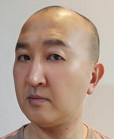 눈밑지방재배치 한 달차, 다크서클 사라져서 얼굴 좋아졌다는 말 들어요 — 아바성형외과 환자 후기 사진