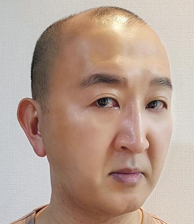 눈밑지방재배치 한 달차, 다크서클 사라져서 얼굴 좋아졌다는 말 들어요 사진 4 — 아바성형외과 눈밑지방재배치 후기
