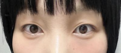 안면거상 환자 후기 — 브라운성형외과에서 김승수 원... (451)