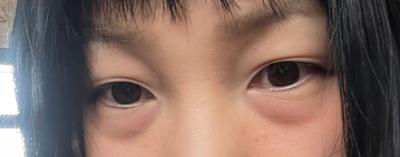 눈밑지방재배치＋중안면거상 9주차, 인상 밝아졌다는 말 정말 많이 들어요 사진 2 — 아바성형외과 눈밑지방재배치 후기