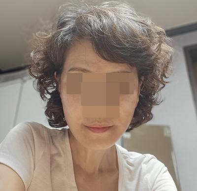 안면거상 하안검 눈밑지방재배치 6주차, 훨씬 젊어졌어요 — 아바성형외과 환자 후기 사진