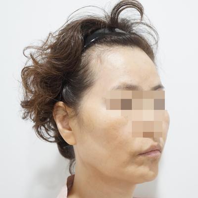 안면거상 하안검 눈밑지방재배치 6주차, 훨씬 젊어졌어요 사진 3 — 아바성형외과 눈밑지방재배치 후기