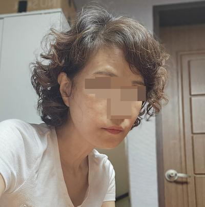 안면거상 하안검 눈밑지방재배치 6주차, 훨씬 젊어졌어요 사진 4 — 아바성형외과 눈밑지방재배치 후기