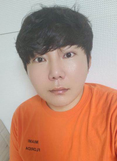 수술 12주차, 걱정 많았는데 지금 보니 참 잘했다 싶어요 — 아바성형외과 환자 후기 사진