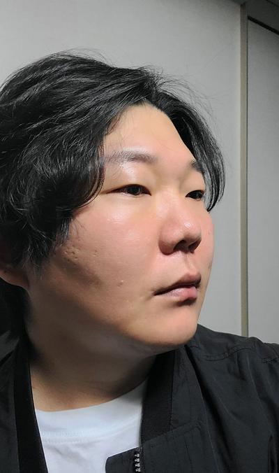 수술 12주차, 걱정 많았는데 지금 보니 참 잘했다 싶어요 사진 3 — 아바성형외과 기타 후기