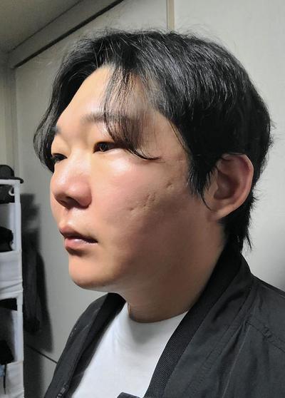 수술 12주차, 걱정 많았는데 지금 보니 참 잘했다 싶어요 사진 4 — 아바성형외과 기타 후기