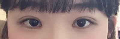 눈성형 환자 후기 — 2월 5일에 수술해서 벌써 ... (454)