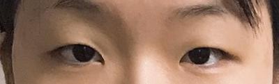 앞트임 눈수술 한 달 후기, 회복 과정 솔직하게 적어봐요 사진 2 — 아바성형외과 쌍꺼풀·눈성형 후기