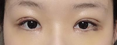 앞트임 눈수술 한 달 후기, 회복 과정 솔직하게 적어봐요 사진 6 — 아바성형외과 쌍꺼풀·눈성형 후기