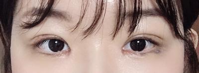 앞트임 눈수술 한 달 후기, 회복 과정 솔직하게 적어봐요 사진 7 — 아바성형외과 쌍꺼풀·눈성형 후기