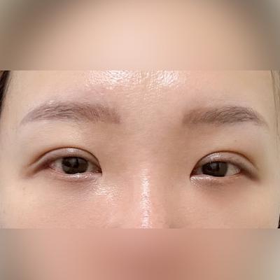 눈밑지방재배치 후기, 정면은 괜찮은데 짝짝이가 아쉬워요 — 아바성형외과 환자 후기 사진
