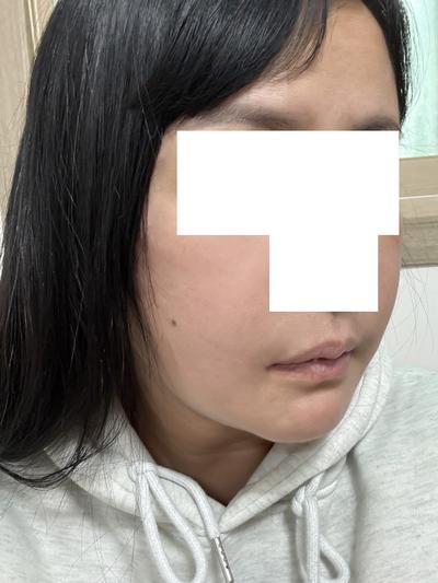 이중턱근육묶기 5주차, 남자 턱선 확 또렷해졌어요 — 아바성형외과 환자 후기 사진