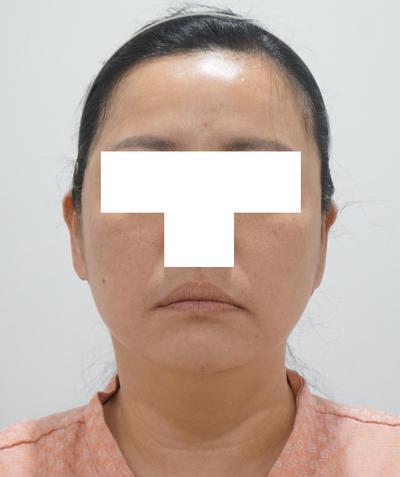 이중턱근육묶기 5주차, 남자 턱선 확 또렷해졌어요 사진 3 — 아바성형외과 이중턱·윤곽 후기