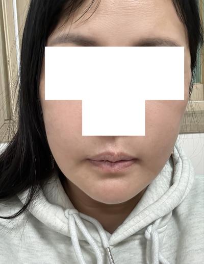 이중턱근육묶기 5주차, 남자 턱선 확 또렷해졌어요 사진 4 — 아바성형외과 이중턱·윤곽 후기