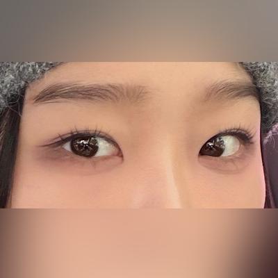 눈밑지방재배치 2주차, 붓기 하나도 안 남아서 대만족 — 아바성형외과 환자 후기 사진