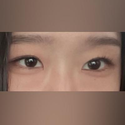 눈밑지방재배치 2주차, 붓기 하나도 안 남아서 대만족 사진 2 — 아바성형외과 눈밑지방재배치 후기