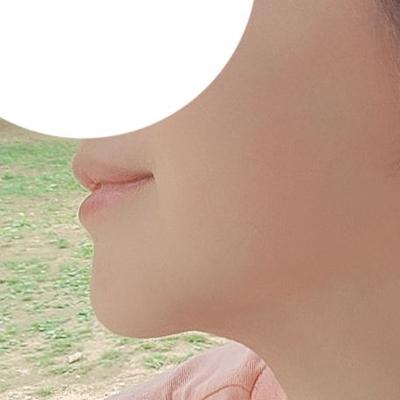 이중턱 근육묶기 후기, 턱선 살아나고 턱밑이 완전 깔끔해졌어요 — 아바성형외과 환자 후기 사진