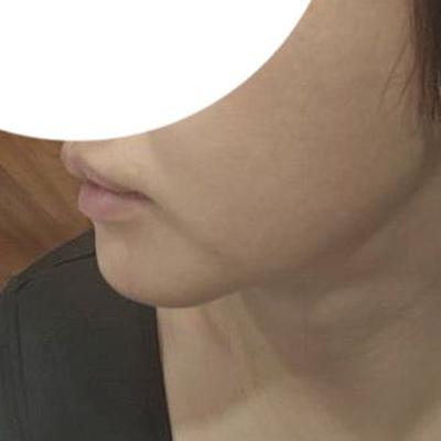 이중턱 근육묶기 후기, 턱선 살아나고 턱밑이 완전 깔끔해졌어요 사진 2 — 아바성형외과 이중턱·윤곽 후기
