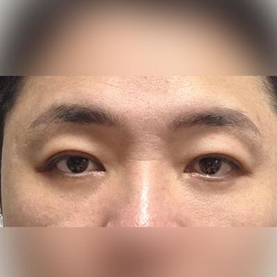 회복기간은 오래 걸렸지만 결과값이 좋아서 완전 만족해요 — 아바성형외과 환자 후기 사진