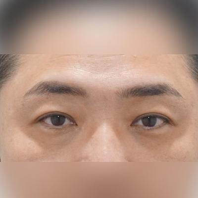 회복기간은 오래 걸렸지만 결과값이 좋아서 완전 만족해요 사진 2 — 아바성형외과 기타 후기
