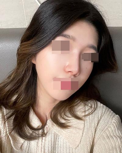 비개방 코수술 3주차, 코끝 얄쌍해져서 진작 할 걸 싶어요 — 아바성형외과 환자 후기 사진