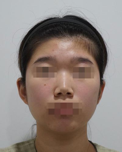 비개방 코수술 3주차, 코끝 얄쌍해져서 진작 할 걸 싶어요 사진 2 — 아바성형외과 코성형 후기