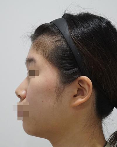 비개방 코수술 3주차, 코끝 얄쌍해져서 진작 할 걸 싶어요 사진 3 — 아바성형외과 코성형 후기
