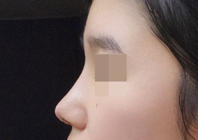 비개방 코수술 3주차, 코끝 얄쌍해져서 진작 할 걸 싶어요 사진 4 — 아바성형외과 코성형 후기