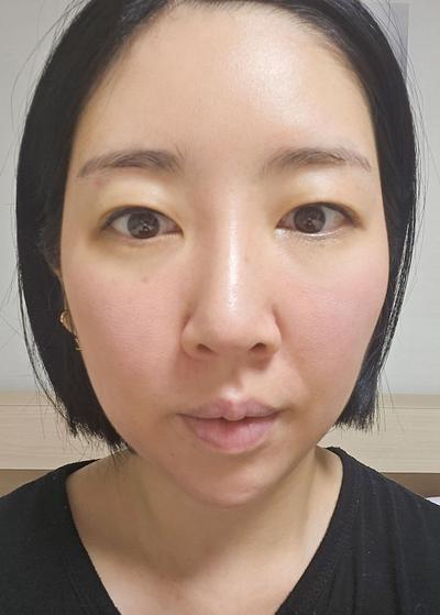 매몰＋자연유착＋윗트임 8주차, 인라인 예쁘게 잡혀 대만족 사진 2 — 아바성형외과 쌍꺼풀·눈성형 후기