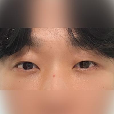 수술 1주차부터 일상생활 가능할 정도로 회복 잘 됐어요 — 아바성형외과 환자 후기 사진